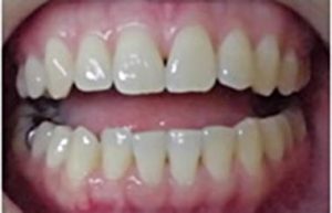 White Cool Whitening メソッド 通院2日 1回目